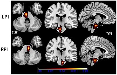 Altered static and dynamic spontaneous neural activity in patients with ischemic pontine stroke